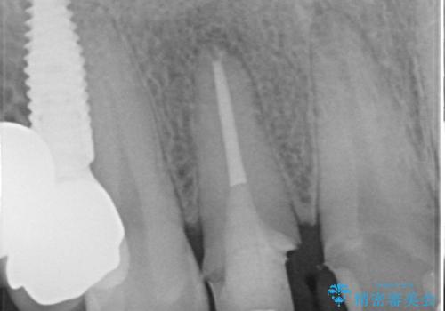 「 放置した虫歯 」 前歯セラミック治療 の治療前