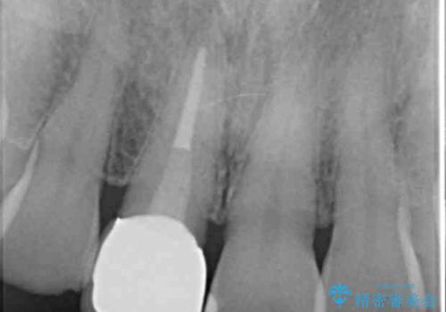 セラミッククラウン 歯ぐきの黒ずみの改善の治療後