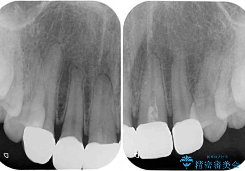 不揃いな前歯のセラミックが気になる オールセラミッククラウンによる補綴治療の治療後