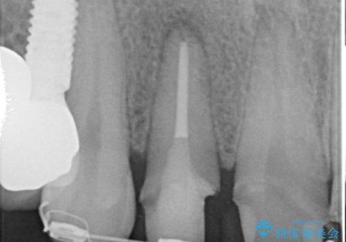 「 放置した虫歯 」 前歯セラミック治療 の治療前