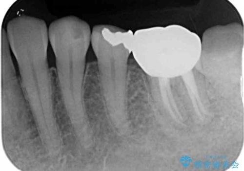 噛むと痛い銀歯 根管治療を伴うやりかえの治療後