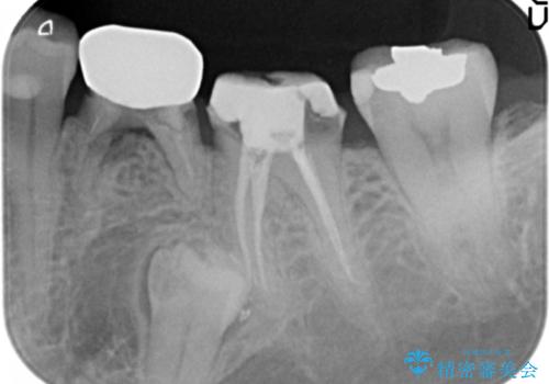 大人になってからの乳歯脱落 セラミックブリッジによる補綴の治療中