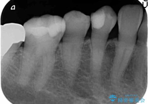 歯が欠けて舌が引っかかる セラミックインレー 50代女性の治療前