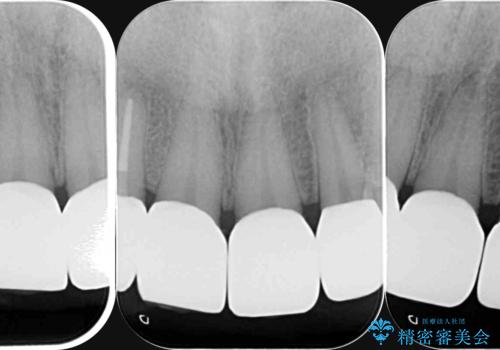 「 放置した虫歯 」 前歯セラミック治療 の治療後