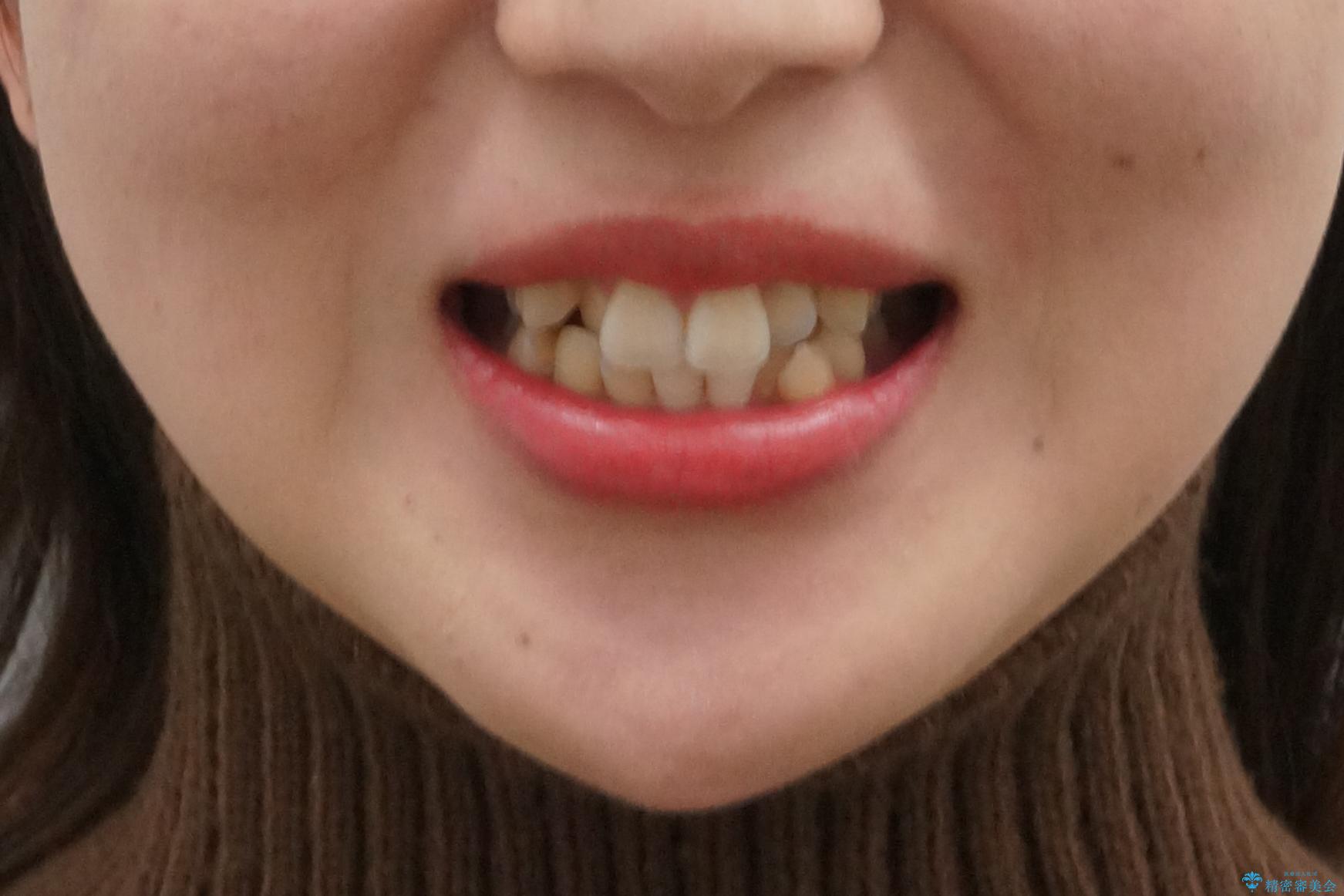 美容整形よりも、自然な美しさを。口元は大事です。の治療前(顔貌)