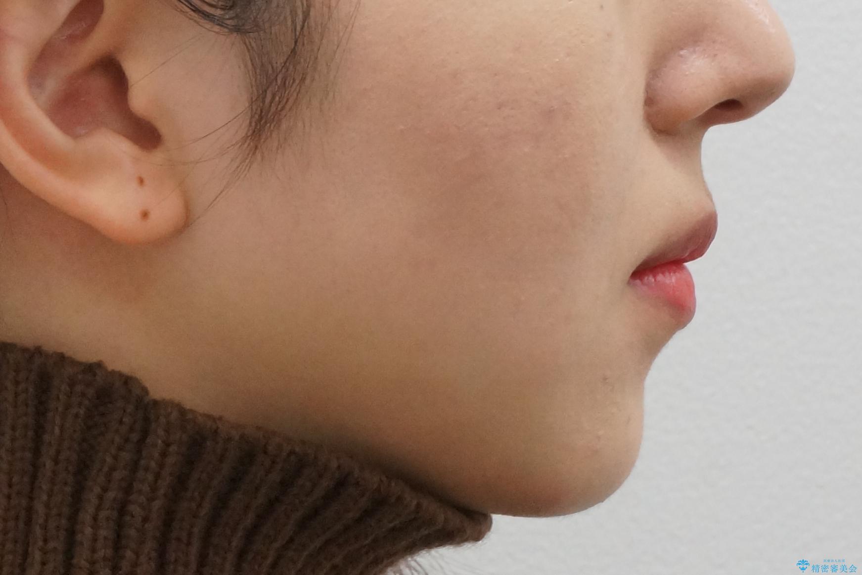 美容整形よりも、自然な美しさを。口元は大事です。の治療前(顔貌)