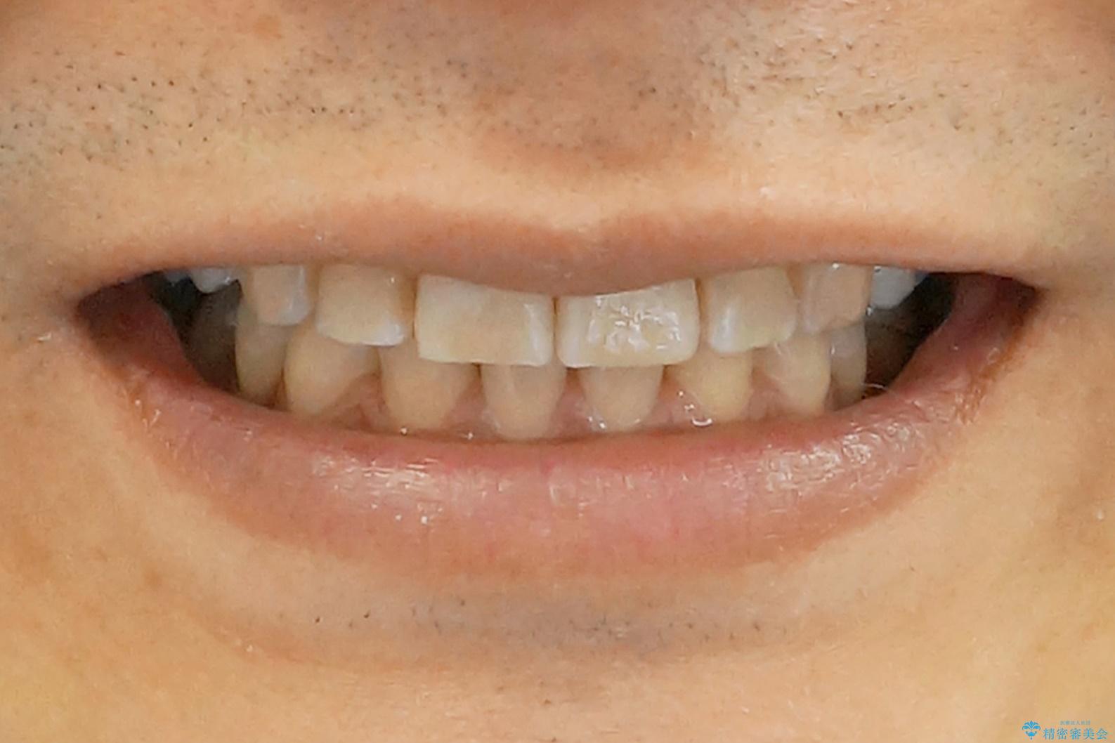 前歯だけ治したい インビザライン・ライト 30代男性の治療後(顔貌)