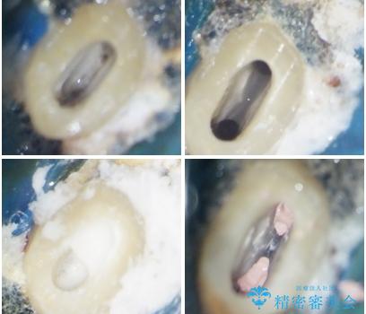 食事をするときに痛む 根管治療とセラミック補綴治療の治療中