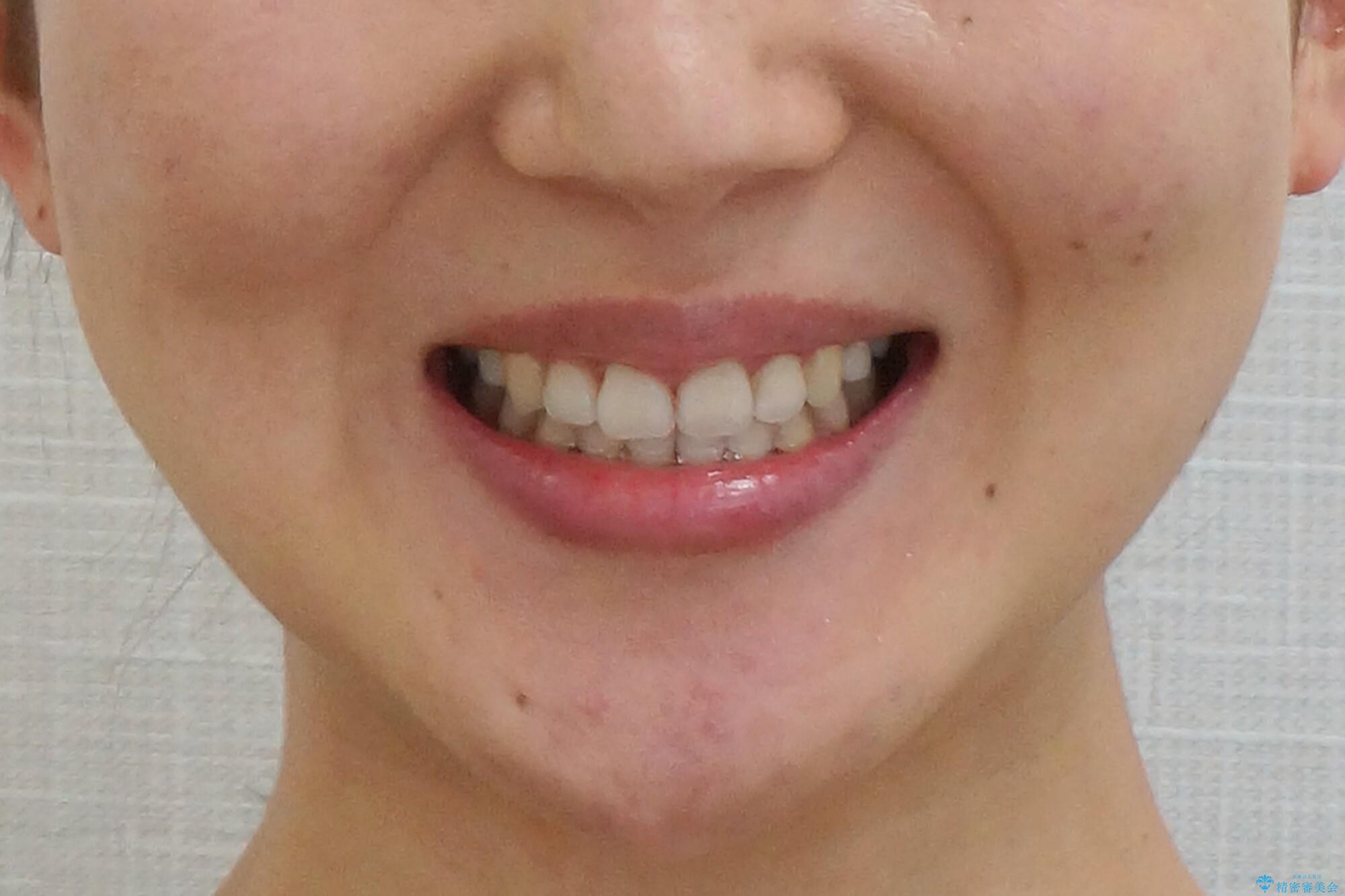 美容整形よりも、自然な美しさを。口元は大事です。の治療後(顔貌)