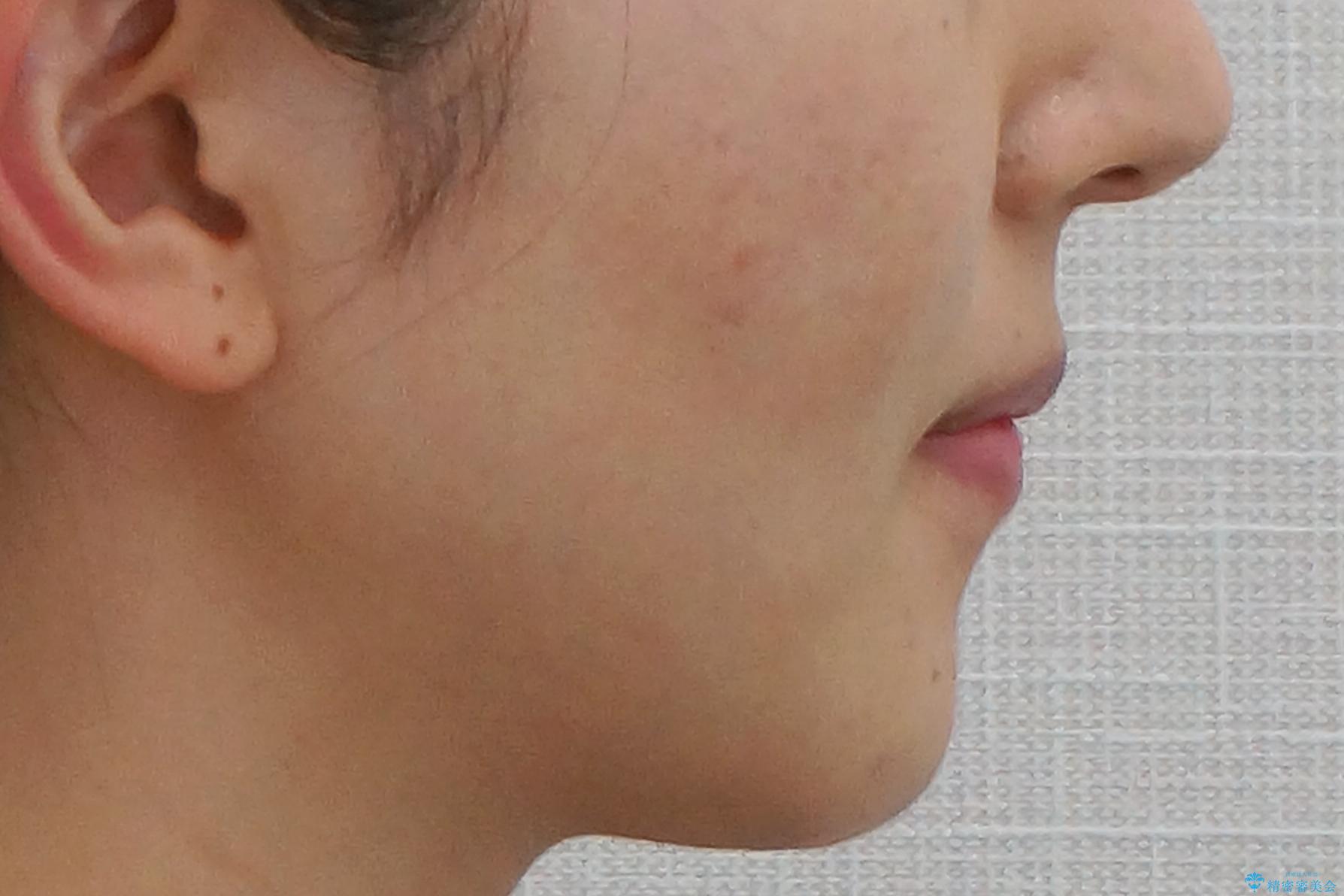 美容整形よりも、自然な美しさを。口元は大事です。の治療後(顔貌)