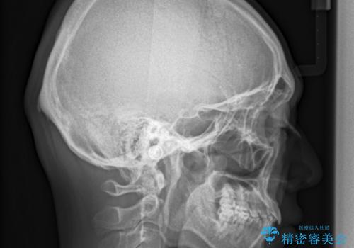 再矯正、後戻りを治したい、マウスピース矯正の治療前