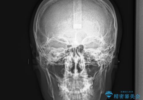 再矯正、後戻りを治したい、マウスピース矯正の治療前