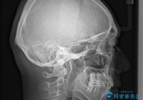 再矯正、後戻りを治したい、マウスピース矯正の治療後