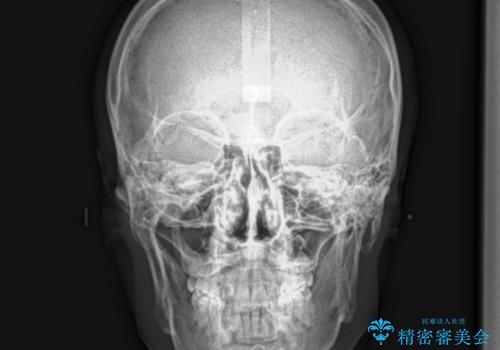 再矯正、後戻りを治したい、マウスピース矯正の治療後
