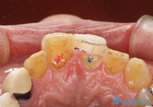 折れた前歯を使えるように、抜かないで残す方法の治療中