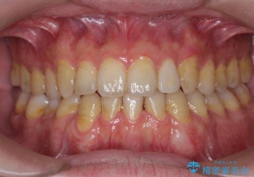 オフィスホワイトニングで、歯を白く爽やかに!の治療前