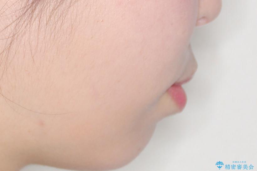 【インビザライン】前歯が出ているのを治したいの治療前(顔貌)