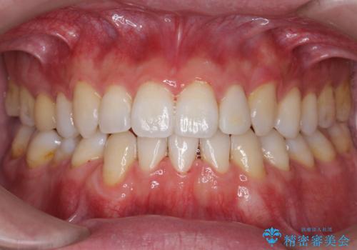 オフィスホワイトニングで、歯を白く爽やかに!