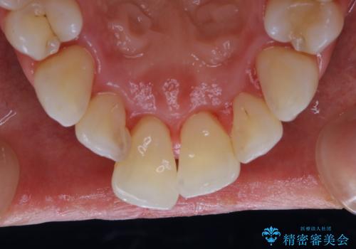 前歯の着色をきれいにの治療後
