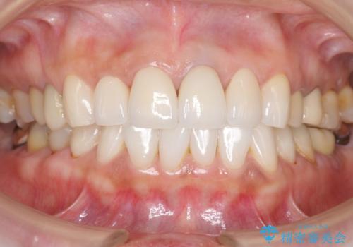 長持ちするセラミック 5年経過症例 50代女性の治療中