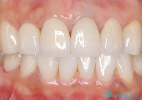 長持ちするセラミック 5年経過症例 50代女性の治療中