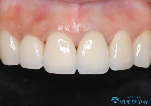 長持ちするセラミック 5年経過症例 50代女性の治療中