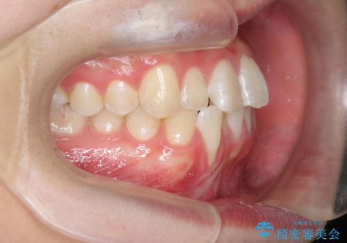 [ Three-incisor ]  歯肉退縮した歯を抜去しマウスピース治療で改善の治療前