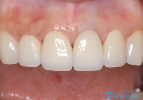 長持ちするセラミック 5年経過症例 50代女性の治療中