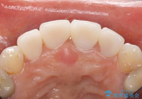 長持ちするセラミック 5年経過症例 50代女性の治療中