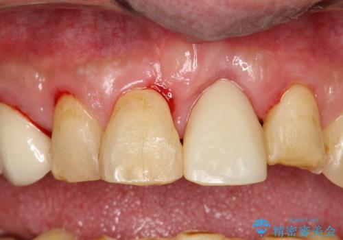 折れた前歯を使えるように、抜かないで残す方法の治療前