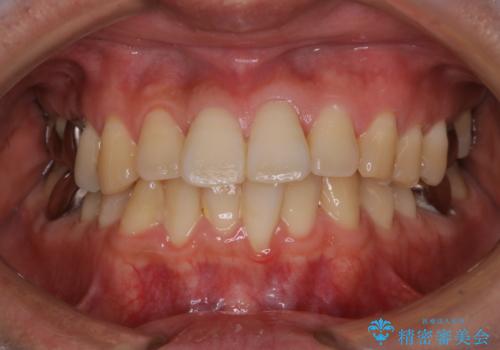 マスクの中で口臭が気になる PMTCで口臭予防の治療前