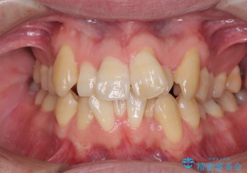 ものが挟まる　著しい叢生を解消　ワイヤー装置による抜歯矯正の症例 治療前