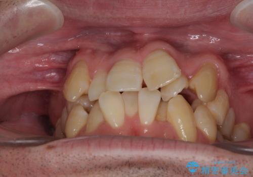 ものが挟まる 著しい叢生を解消 ワイヤー装置による抜歯矯正の治療前