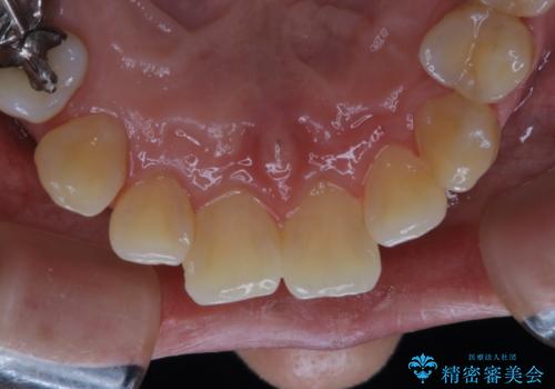 マスクの中で口臭が気になる PMTCで口臭予防の治療前