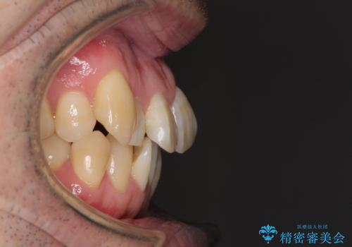 ものが挟まる 著しい叢生を解消 ワイヤー装置による抜歯矯正の治療前