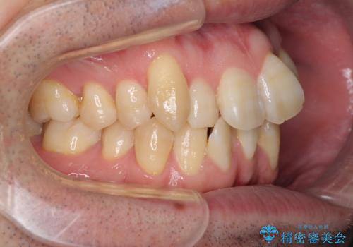 ものが挟まる 著しい叢生を解消 ワイヤー装置による抜歯矯正の治療前