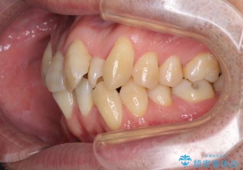 ものが挟まる 著しい叢生を解消 ワイヤー装置による抜歯矯正の治療前