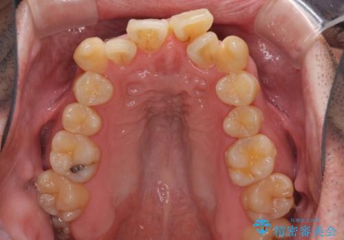 ものが挟まる 著しい叢生を解消 ワイヤー装置による抜歯矯正の治療前