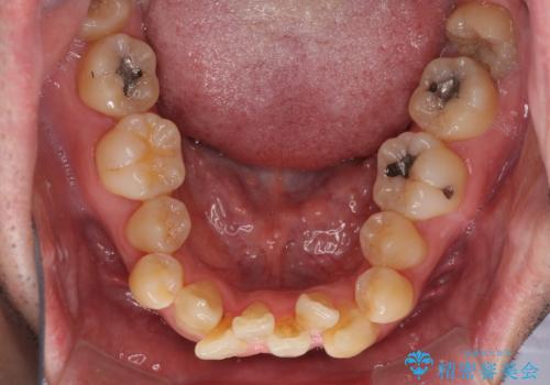 ものが挟まる 著しい叢生を解消 ワイヤー装置による抜歯矯正の治療前