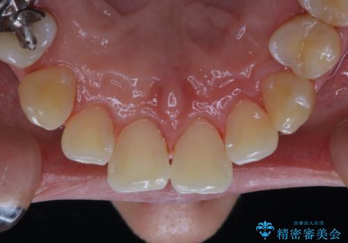 マスクの中で口臭が気になる PMTCで口臭予防の治療後