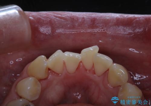 マスクの中で口臭が気になる PMTCで口臭予防の治療後