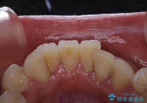 10年以上ぶりに歯のクリーニング