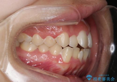 オープンバイト(開咬)を非抜歯インビザラインで治すの治療前