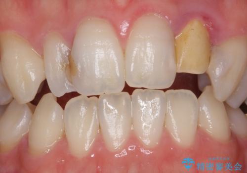 歯の外部吸収 難しい根の治療 30代男性の治療前