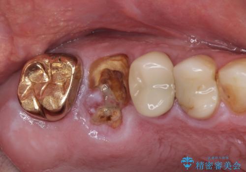 抜歯が必要な左右の奥歯 ブリッジとインプラントによる奥歯の補綴治療の治療前