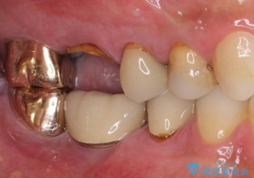 抜歯が必要な左右の奥歯 ブリッジとインプラントによる奥歯の補綴治療の治療前