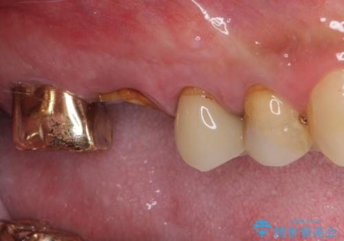 抜歯が必要な左右の奥歯 ブリッジとインプラントによる奥歯の補綴治療の治療前