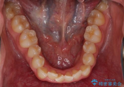 オープンバイト(開咬)を非抜歯インビザラインで治すの治療前