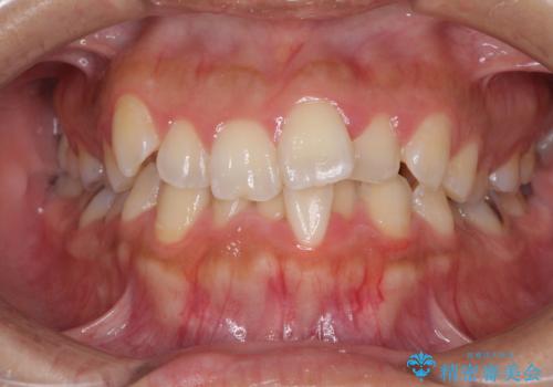 前歯のデコボコをインビザラインでスッキリとの症例 治療前