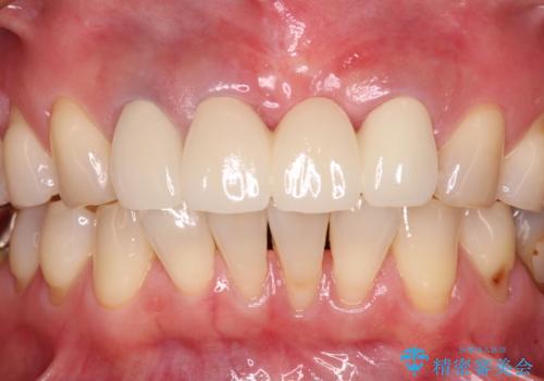 抜かなければいけない前歯 歯肉移植を用いたオールセラミックブリッジの治療後